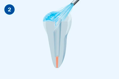 Применение Люксакор Z Дуал Смартмикс - этап 2